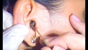 kekotoran terimpak di telinga impacted earwax